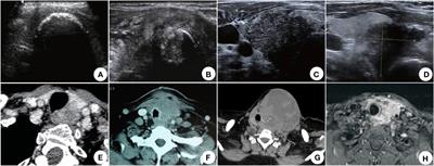 Progress in diagnosing and treating thyroid squamous cell carcinoma under the 5th edition of WHO classification